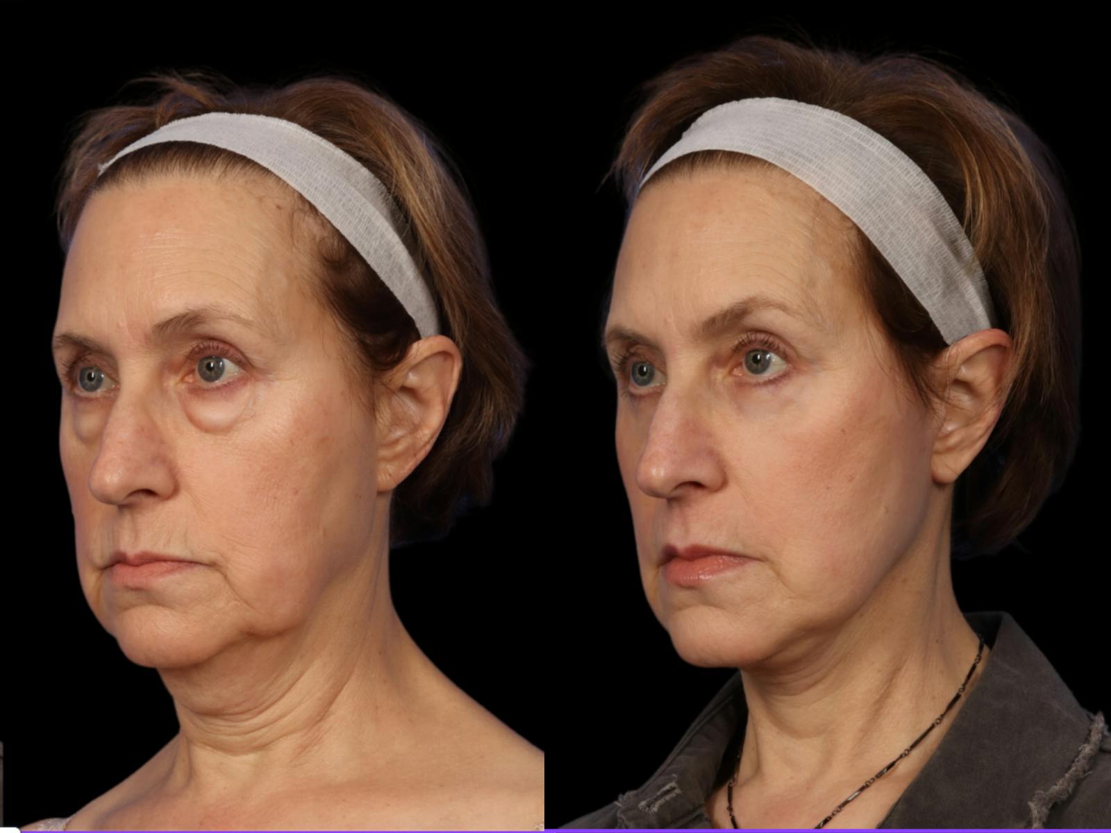 Facelift Before & After Gallery - Patient 648558 - Image 2