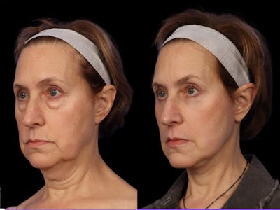 Facelift Before & After Gallery - Patient 648558 - Image 2
