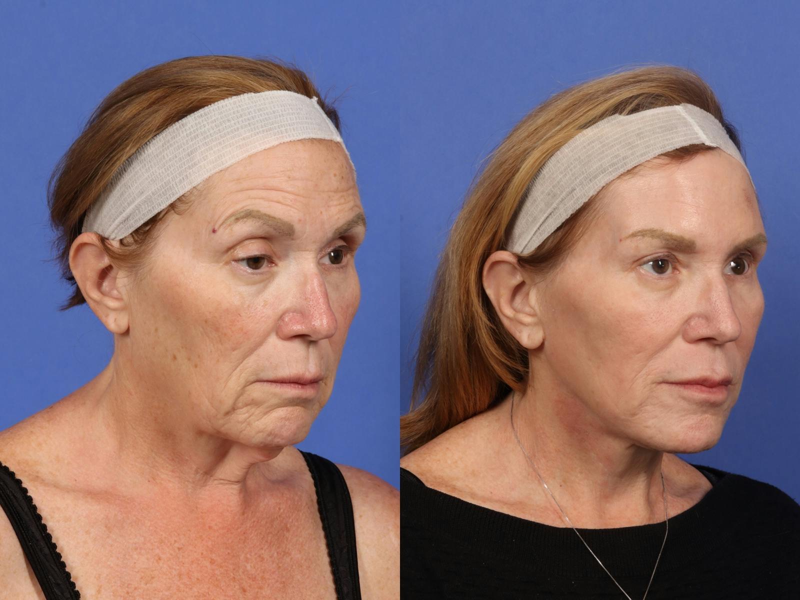 Facelift Before & After Gallery - Patient 140809 - Image 1
