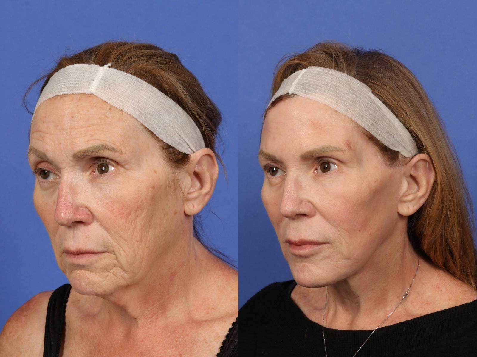 Facelift Before & After Gallery - Patient 140809 - Image 2