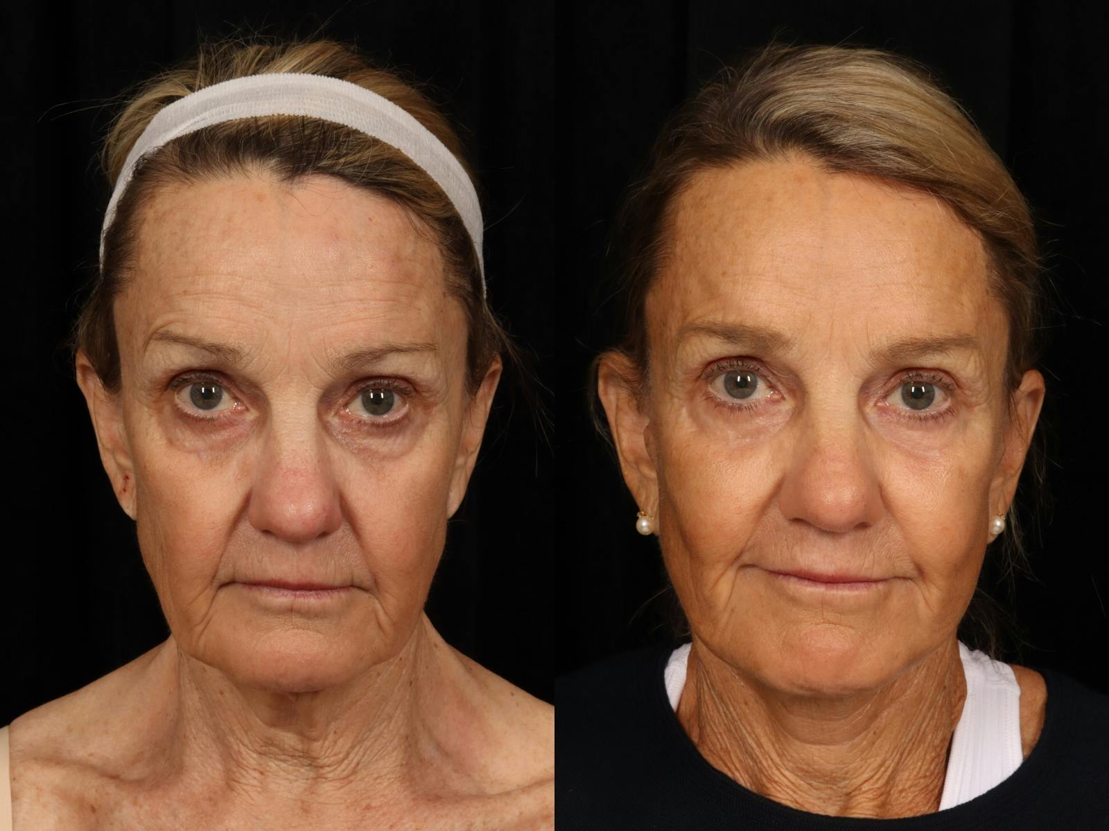Facelift Before & After Gallery - Patient 414310 - Image 1