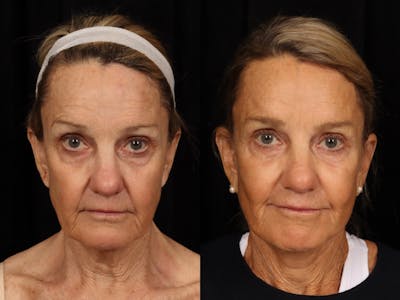 Laser Skin Resurfacing Before & After Gallery - Patient 230044 - Image 1