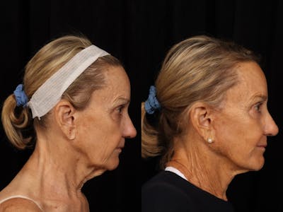 Facelift Before & After Gallery - Patient 414310 - Image 2