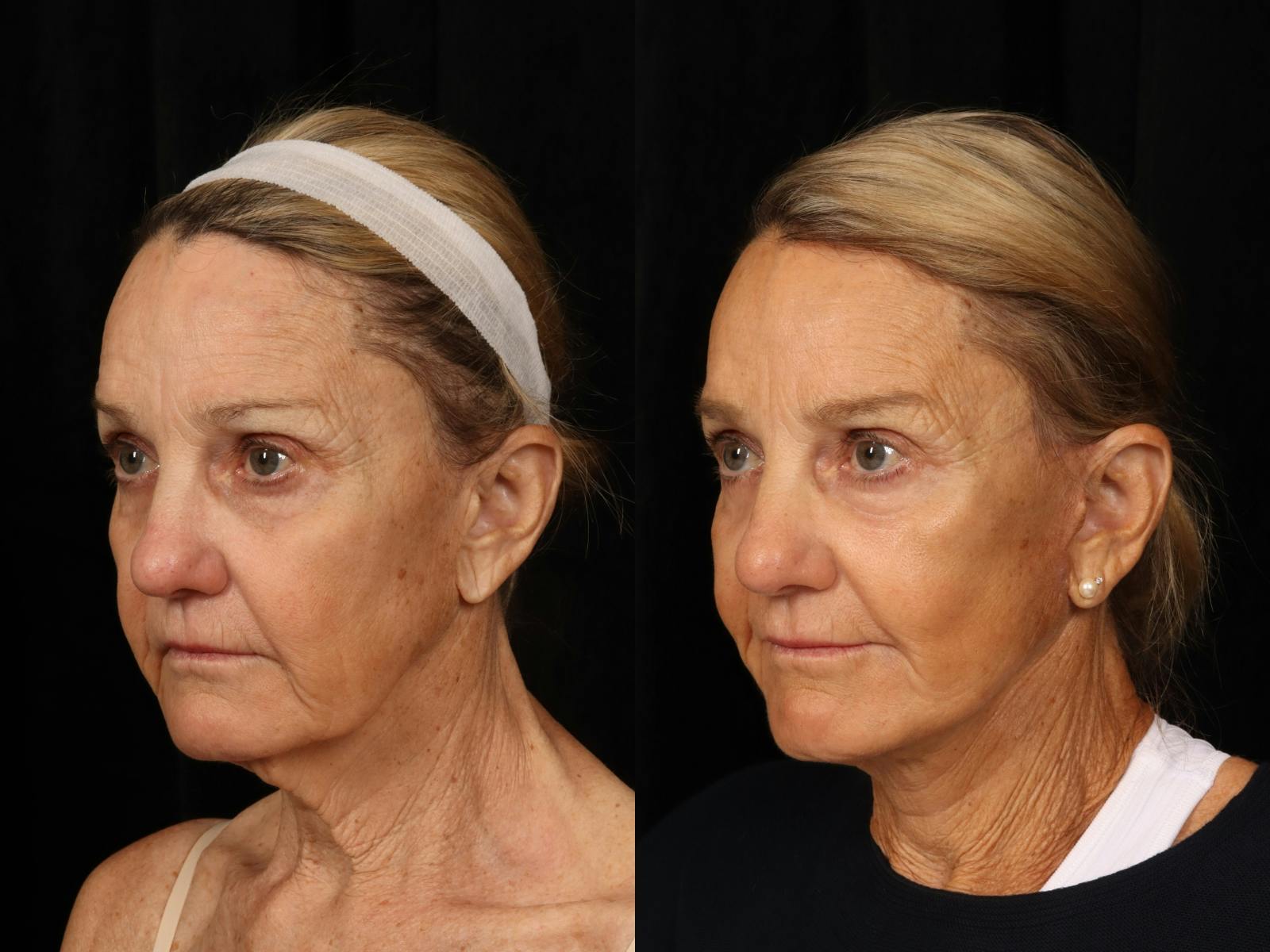 Facelift Before & After Gallery - Patient 414310 - Image 3