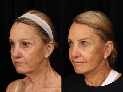 Facelift Before & After Gallery - Patient 414310 - Image 3