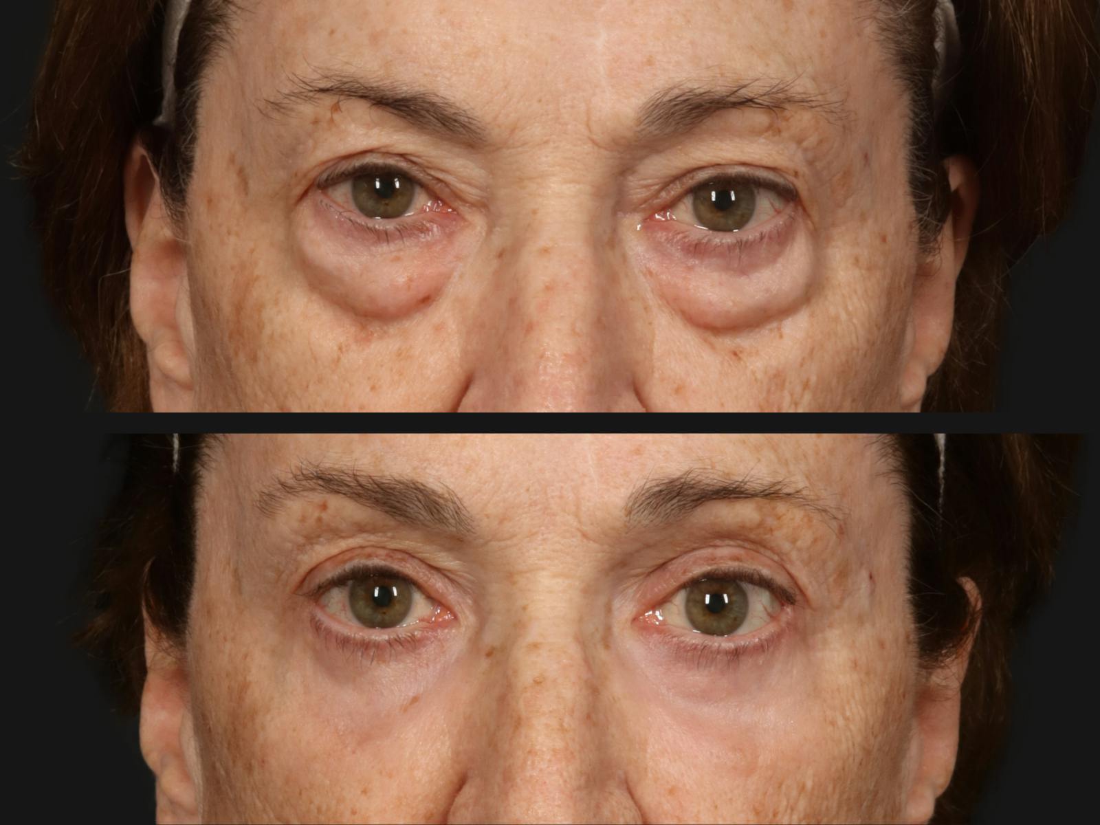 Blepharoplasty Before & After Gallery - Patient 391844 - Image 2