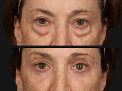 Blepharoplasty Before & After Gallery - Patient 391844 - Image 2