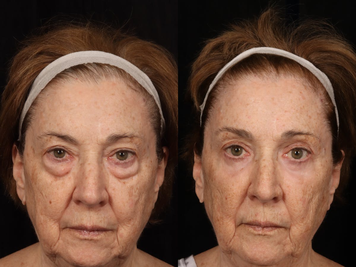 Laser Skin Resurfacing Before & After Gallery - Patient 129852 - Image 1