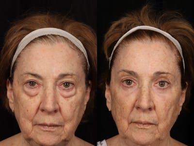 Blepharoplasty Before & After Gallery - Patient 391844 - Image 1