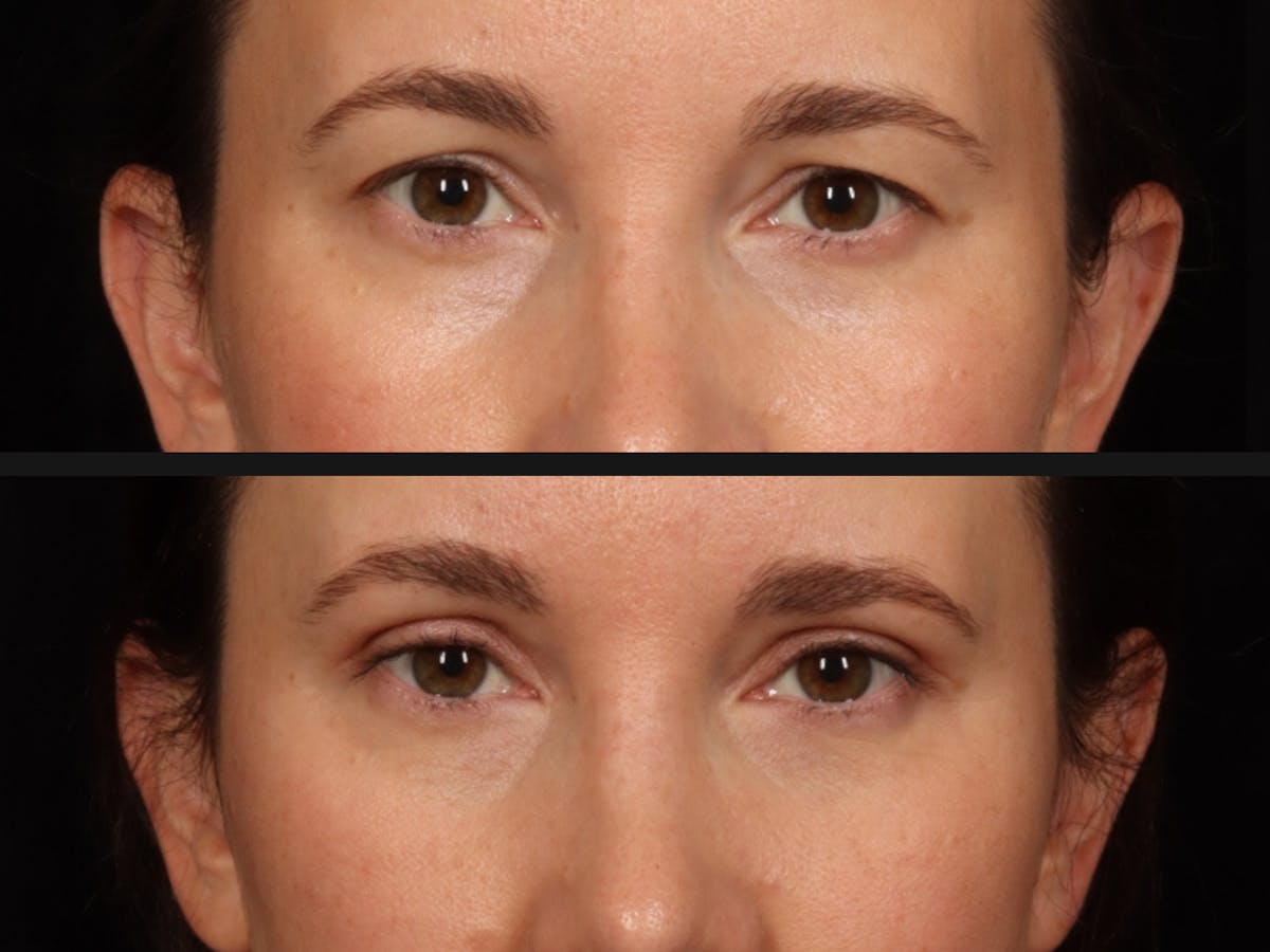 Blepharoplasty Before & After Gallery - Patient 295293 - Image 2