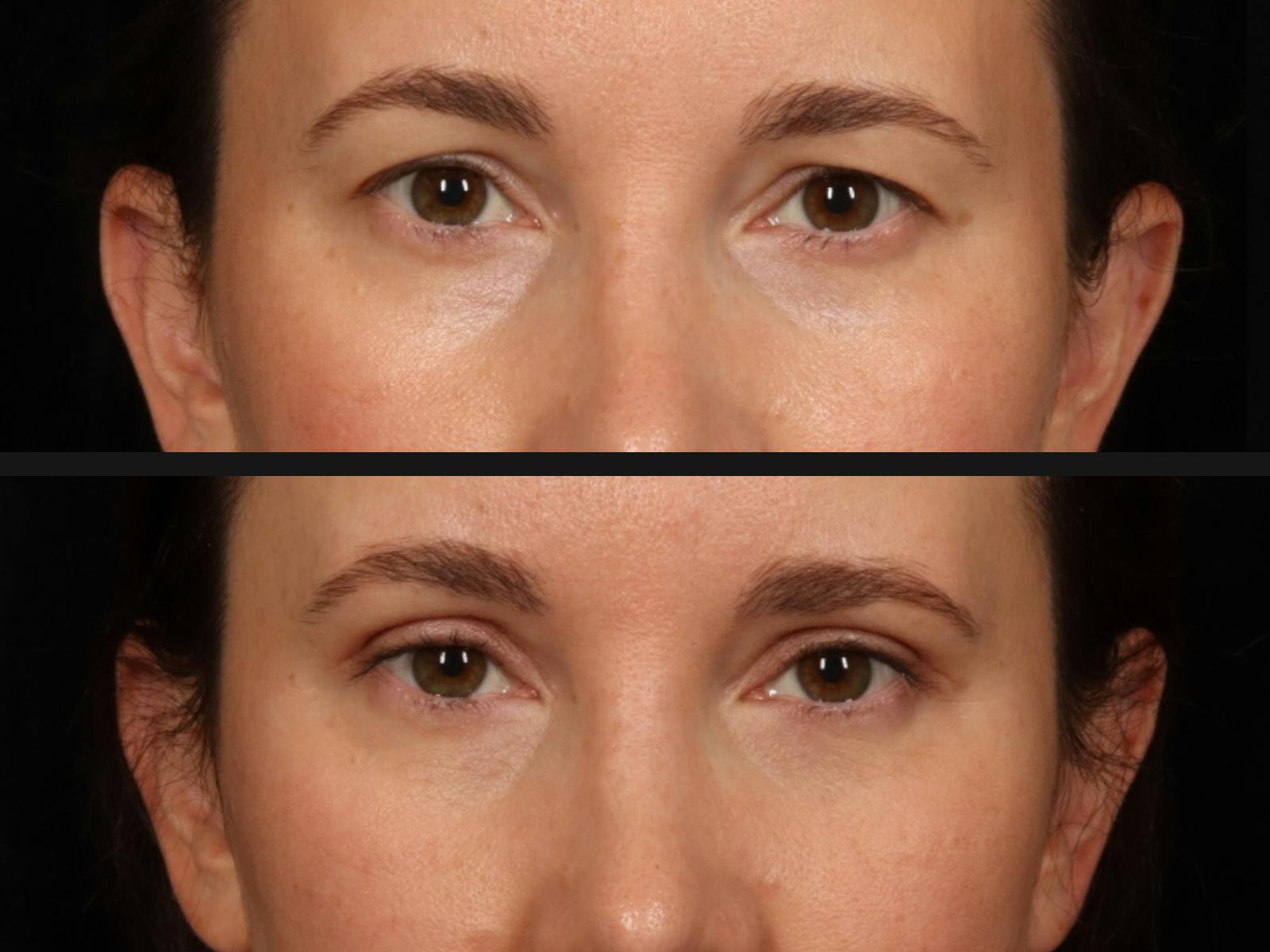 Blepharoplasty Before & After Gallery - Patient 295293 - Image 2