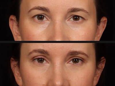 Blepharoplasty Before & After Gallery - Patient 295293 - Image 2