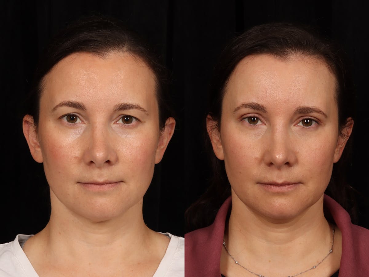 Blepharoplasty Before & After Gallery - Patient 295293 - Image 1