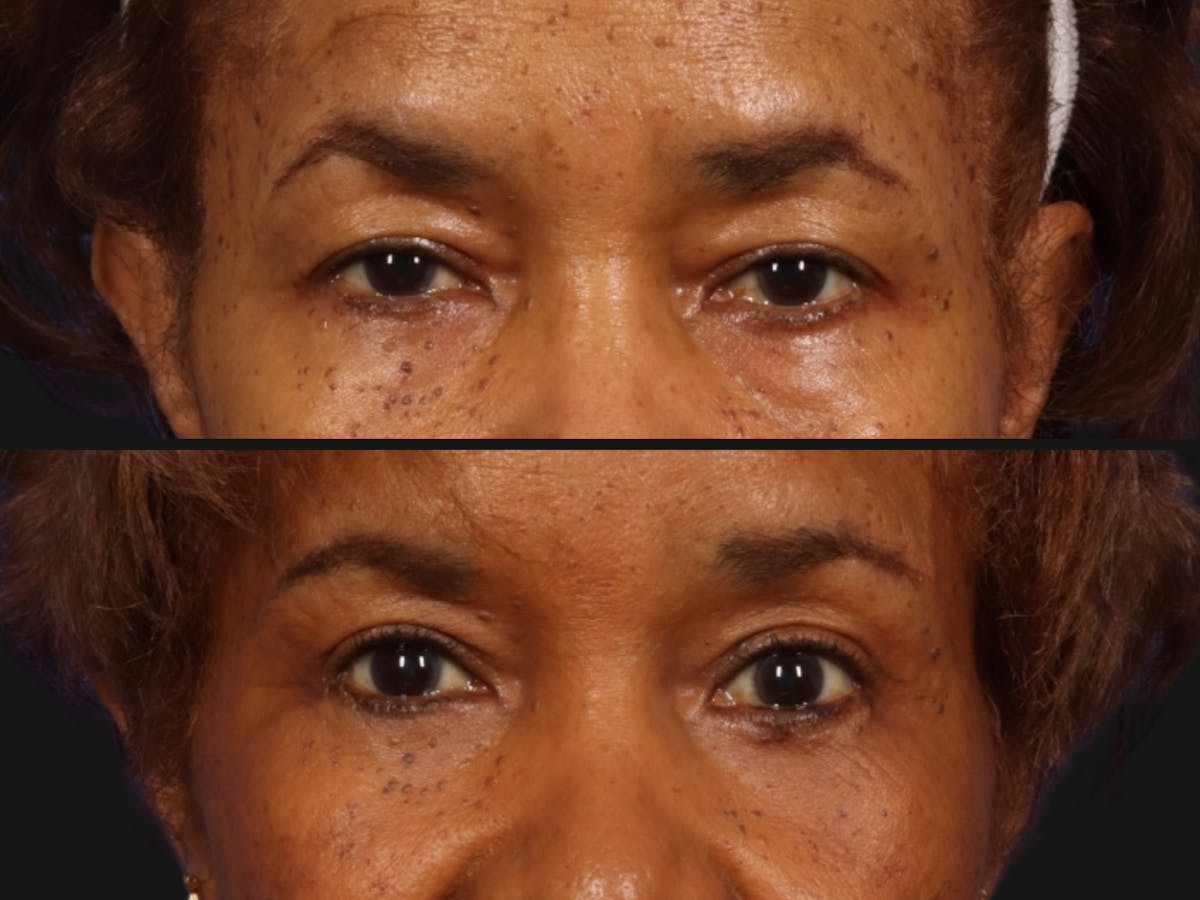 Brow Lift Before & After Gallery - Patient 918032 - Image 2