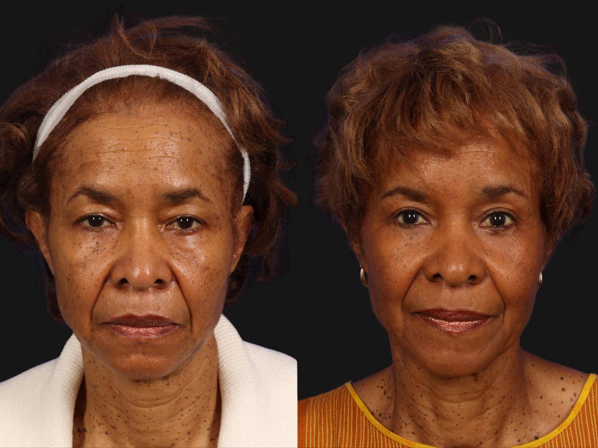 Brow Lift Before & After Gallery - Patient 918032 - Image 1