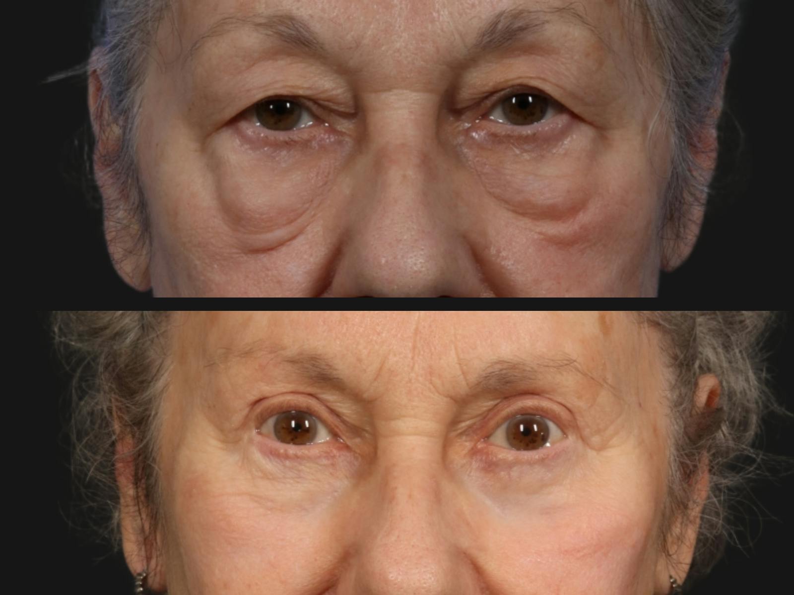 Festoon Surgery Before & After Gallery - Patient 152340 - Image 2