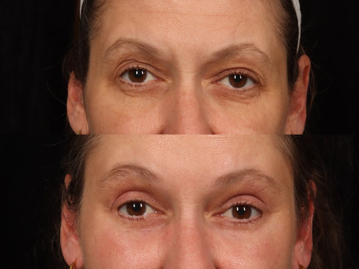 Blepharoplasty Before & After Gallery - Patient 439029 - Image 1