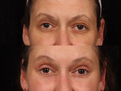 Blepharoplasty Before & After Gallery - Patient 439029 - Image 1