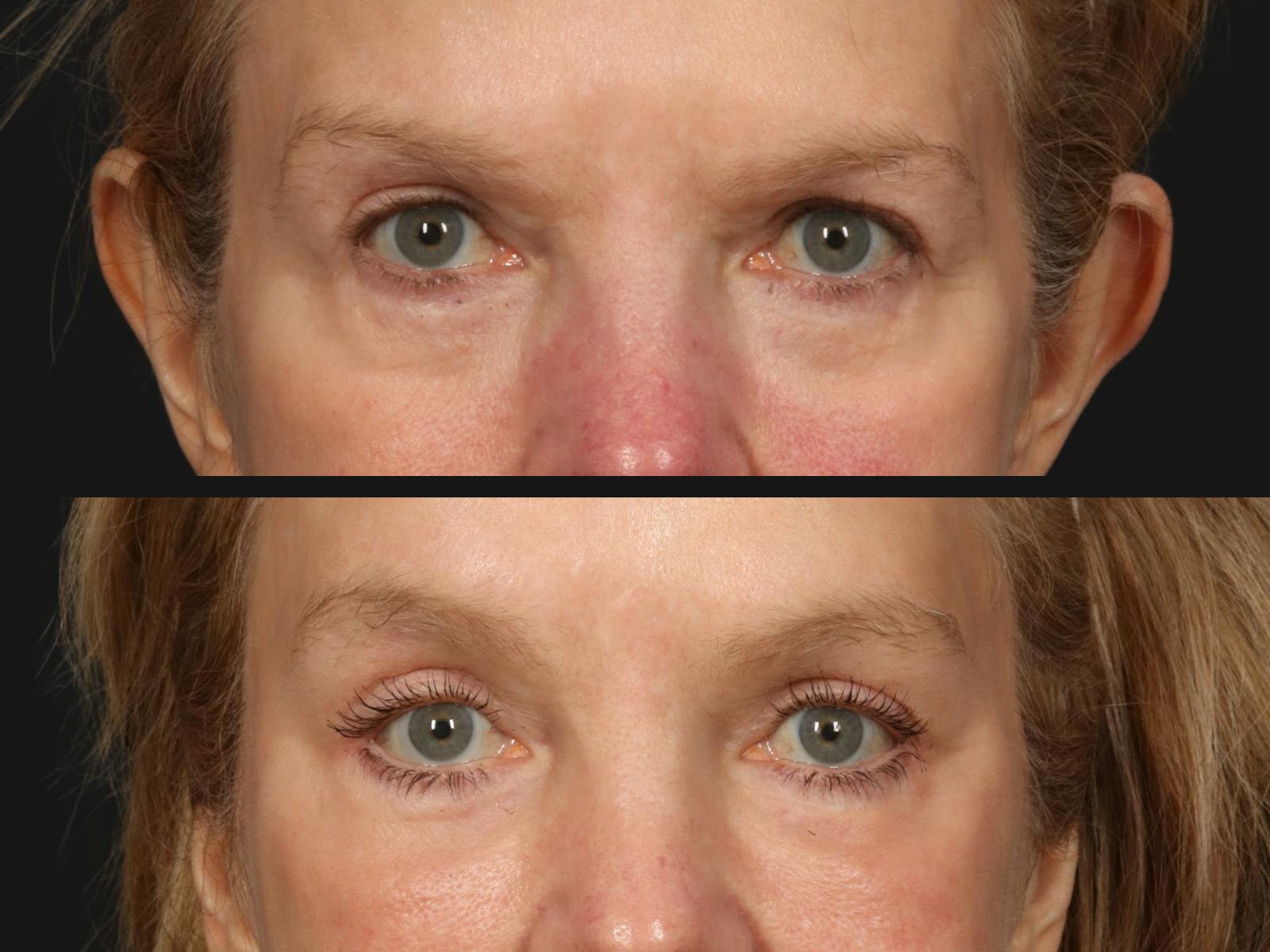 Blepharoplasty Before & After Gallery - Patient 165537 - Image 2