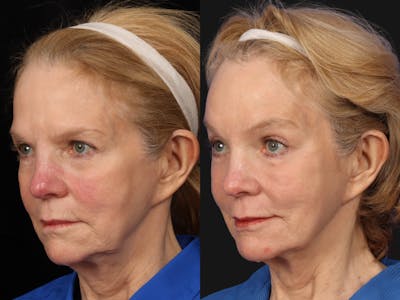 Mid Facelift Before & After Gallery - Patient 257034 - Image 3