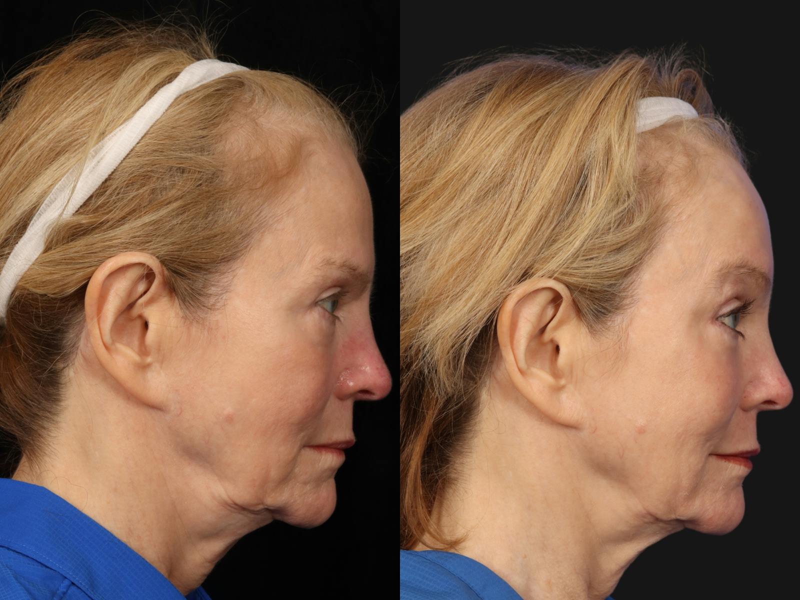 Laser Skin Resurfacing Before & After Gallery - Patient 108183 - Image 4