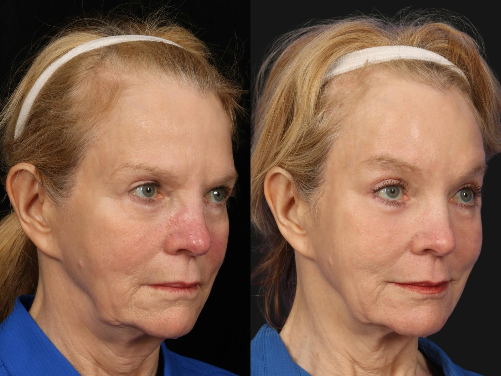 Laser Skin Resurfacing Before & After Gallery - Patient 108183 - Image 2
