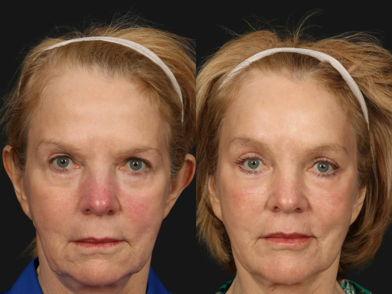 Blepharoplasty Before & After Gallery - Patient 165537 - Image 1