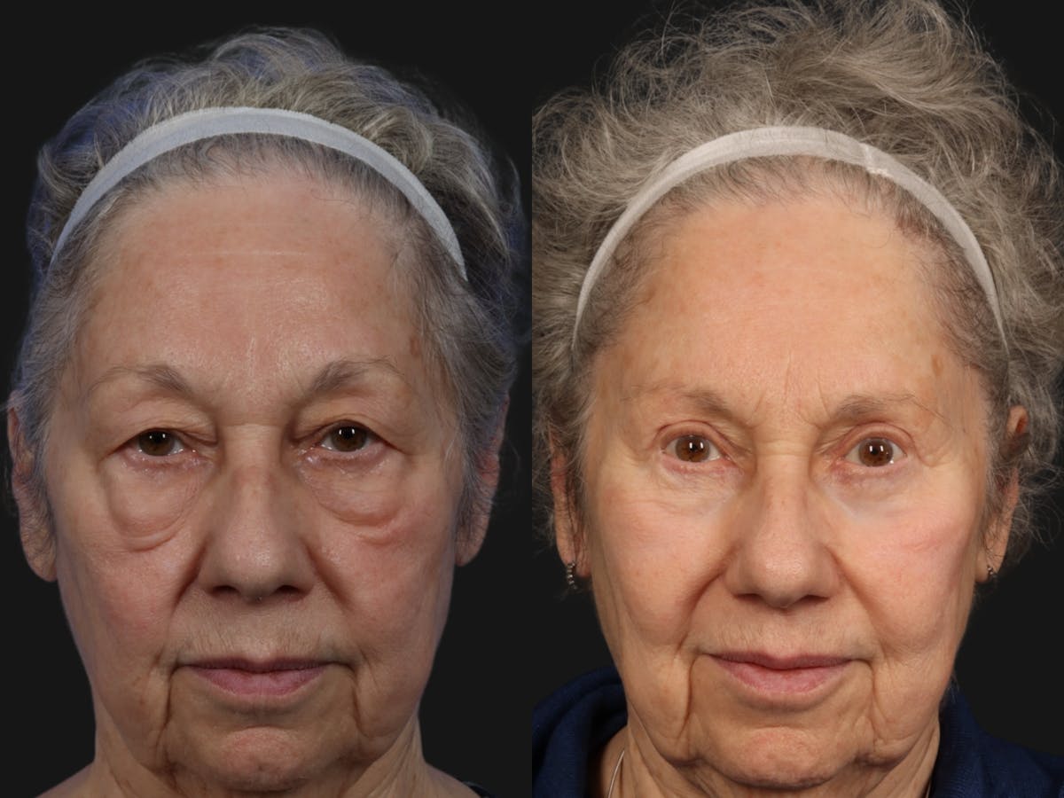 Brow Lift Before & After Gallery - Patient 994319 - Image 2