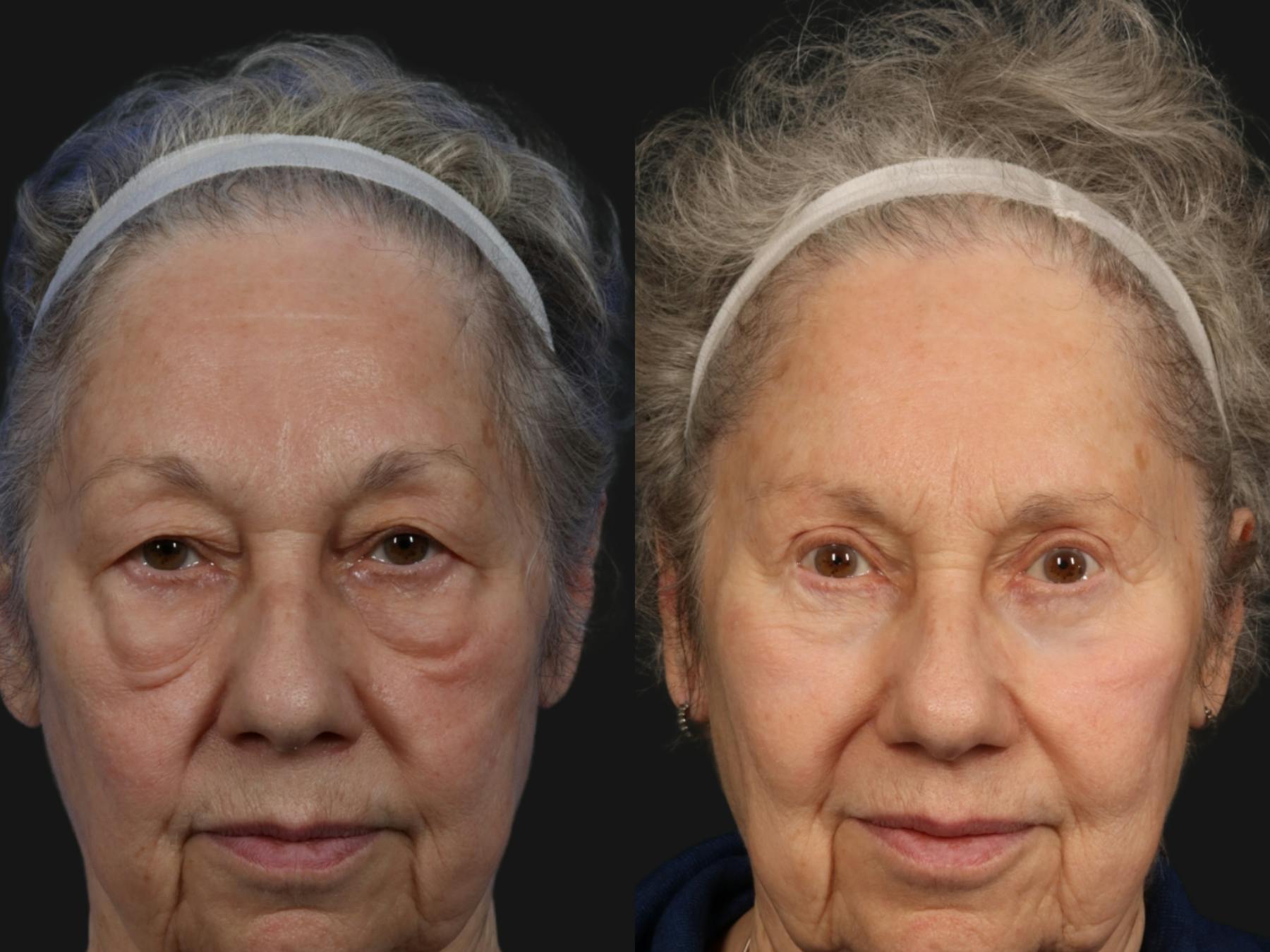 Festoon Surgery Before & After Gallery - Patient 152340 - Image 1
