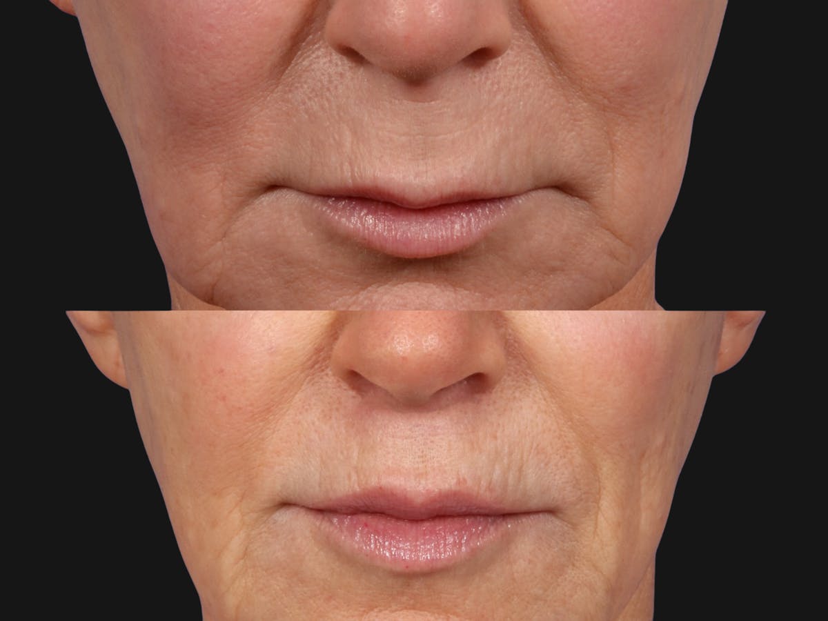 Lip Lift Before & After Gallery - Patient 383883 - Image 1