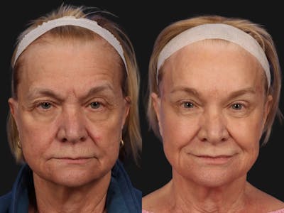 Blepharoplasty Before & After Gallery - Patient 239793 - Image 1