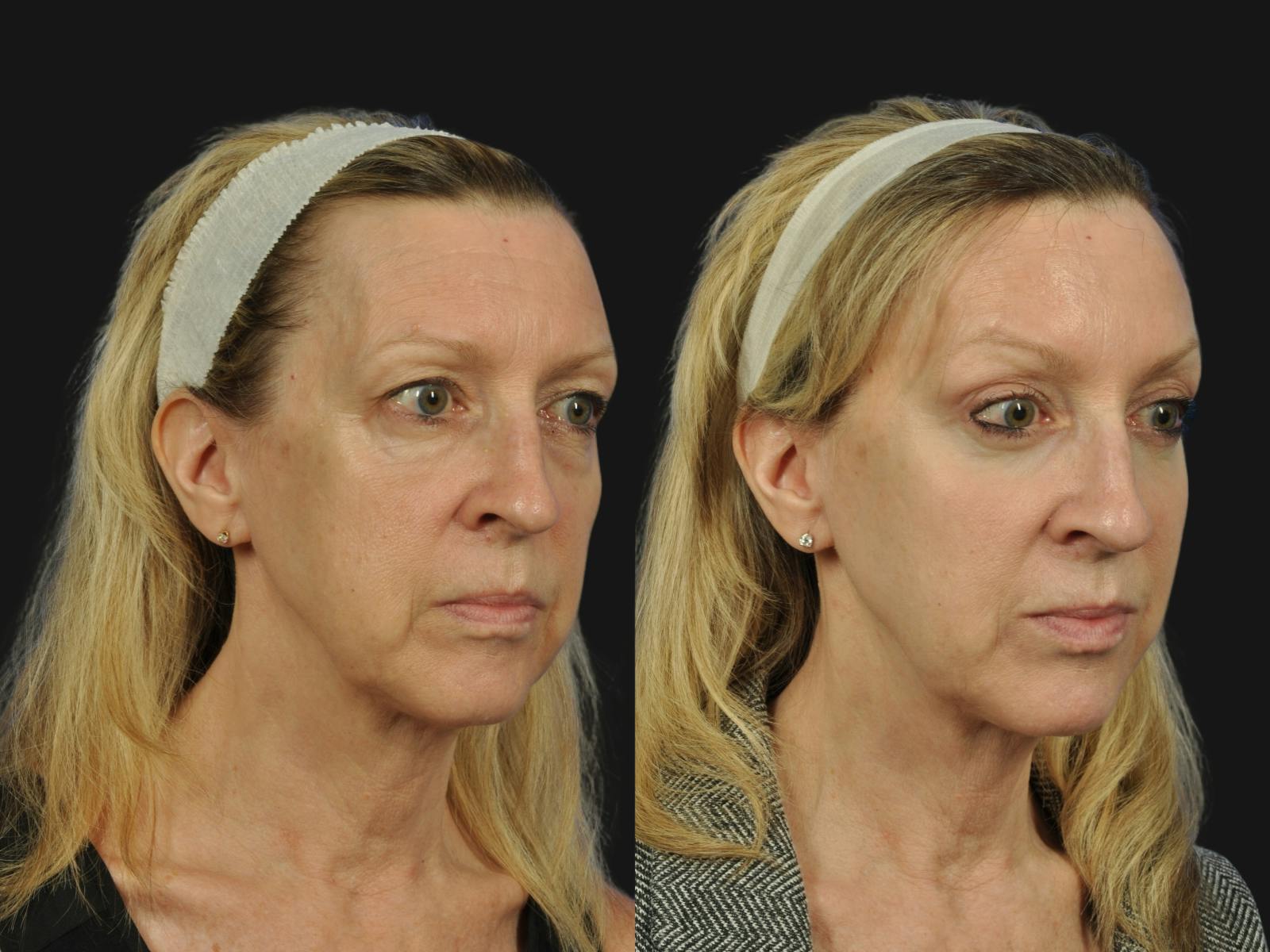 Liposculpture Before & After Gallery - Patient 796956 - Image 2