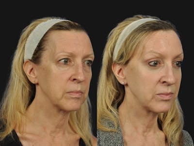 Mid Facelift Before & After Gallery - Patient 266285 - Image 2