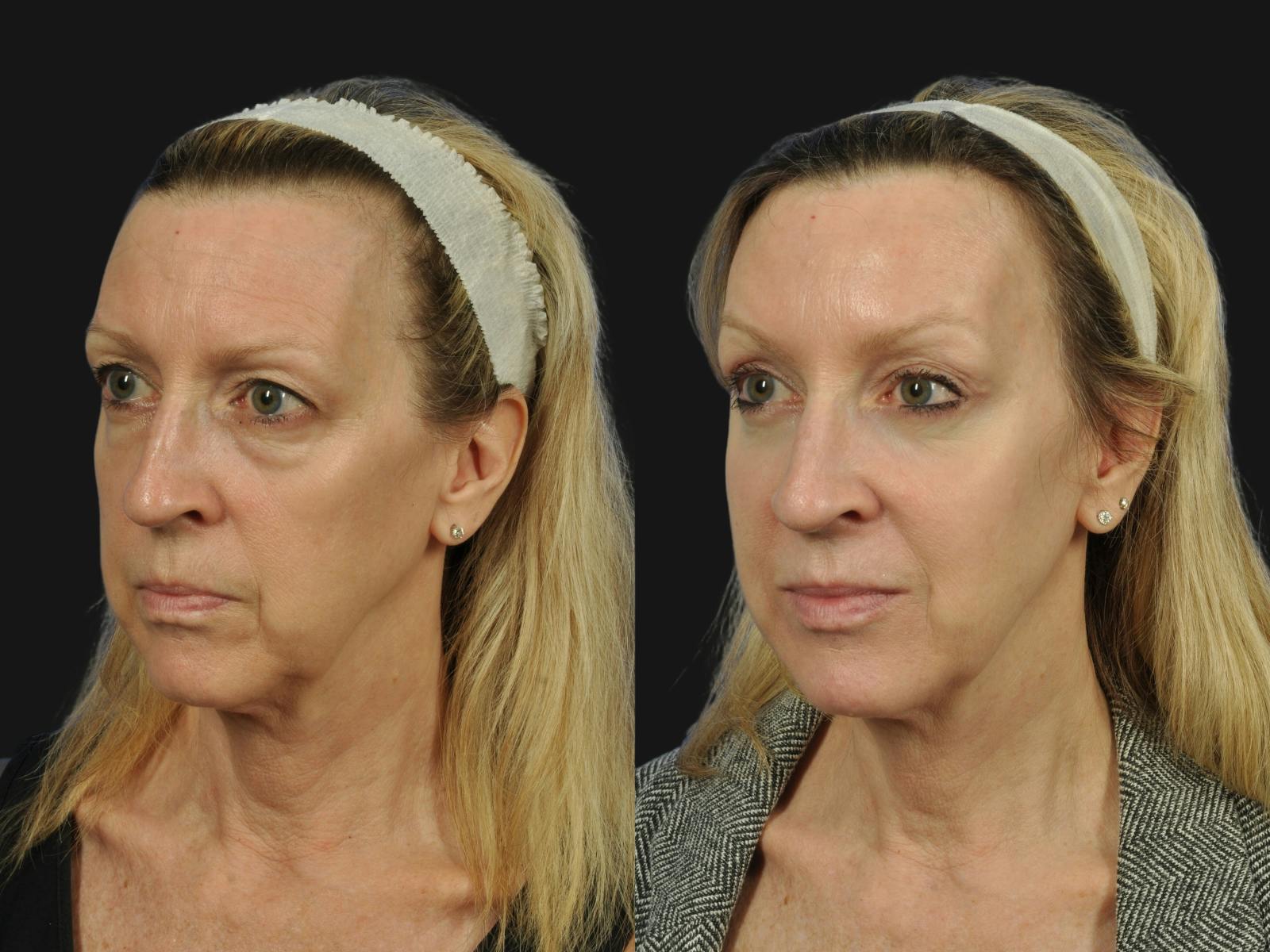 Liposculpture Before & After Gallery - Patient 796956 - Image 3