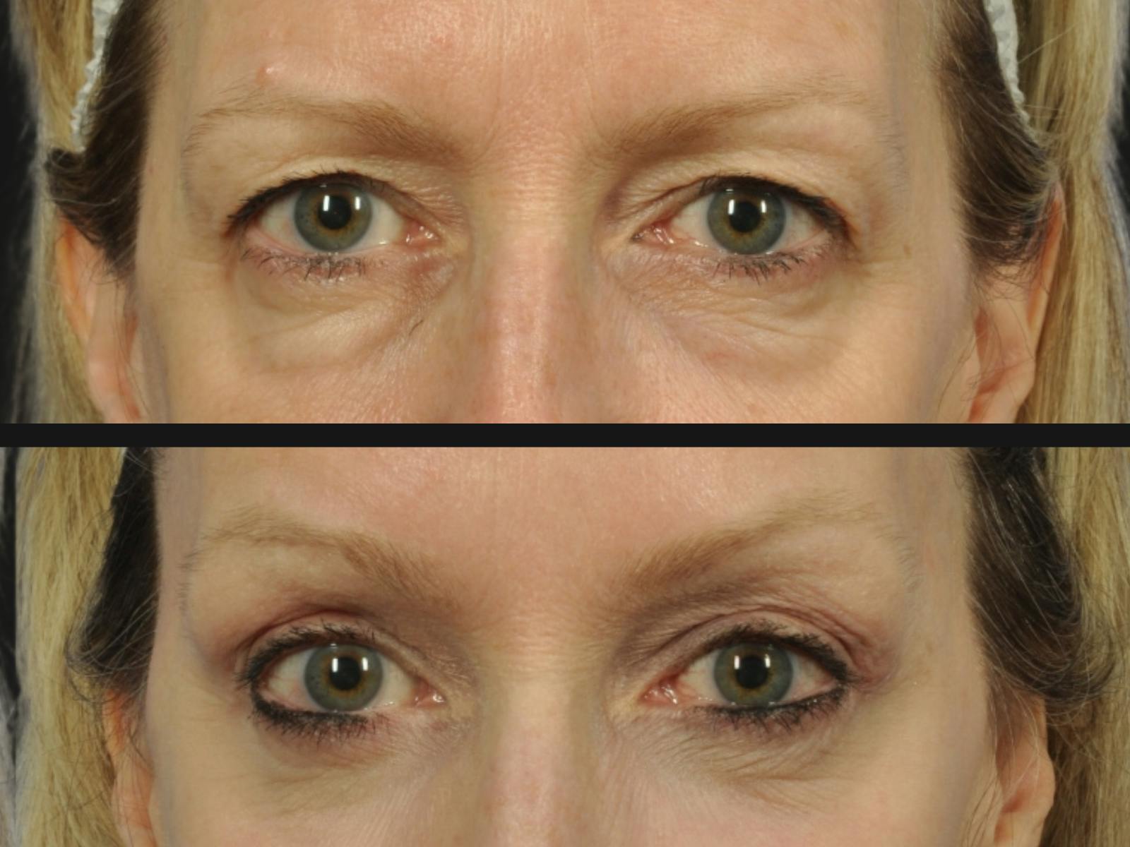 Brow Lift Before & After Gallery - Patient 973952 - Image 2