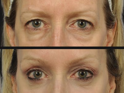Brow Lift Before & After Gallery - Patient 973952 - Image 2