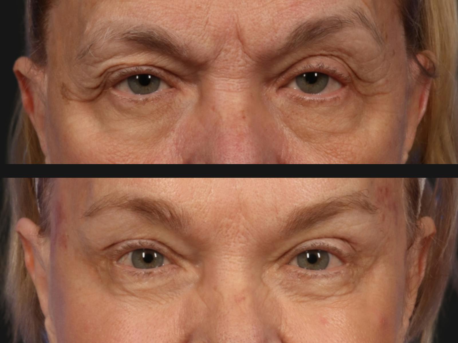 Brow Lift Before & After Gallery - Patient 669159 - Image 2