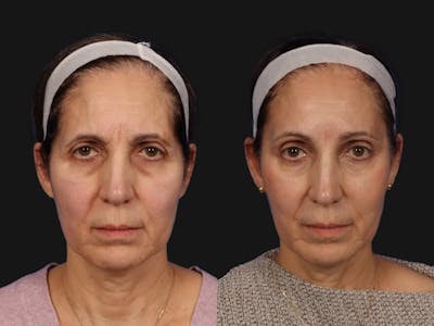 Mid Facelift Before & After Gallery - Patient 925564 - Image 1
