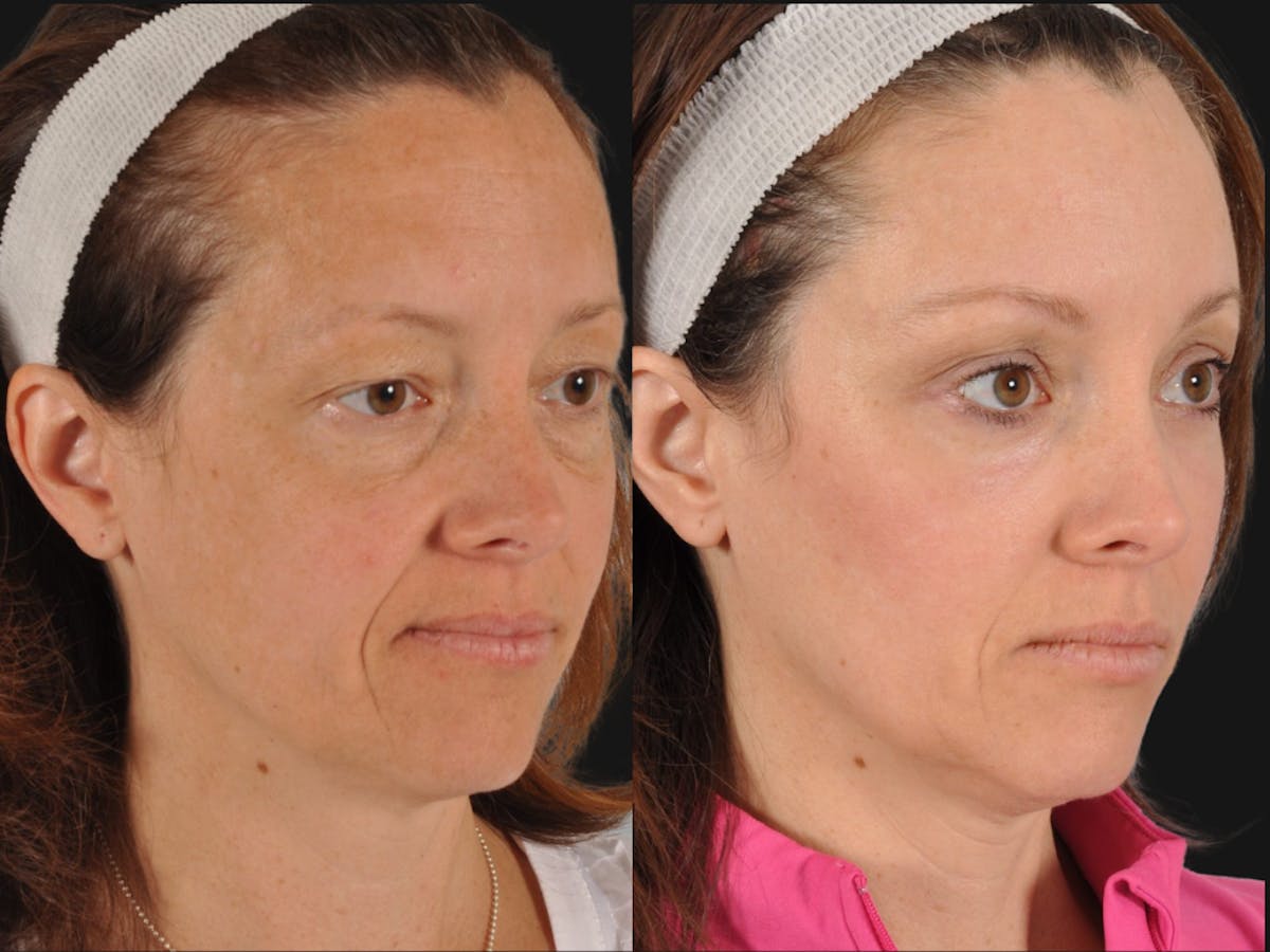 Mid Facelift Before & After Gallery - Patient 394554 - Image 3