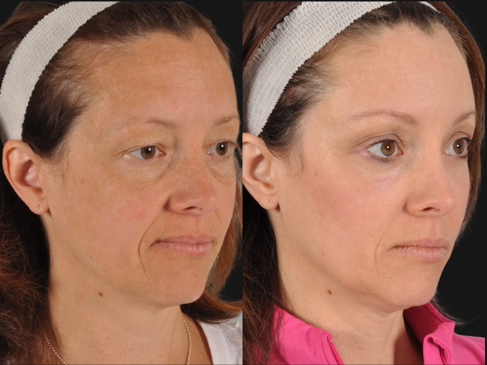 Mid Facelift Before & After Gallery - Patient 394554 - Image 3
