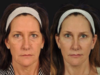 Mid Facelift Before & After Gallery - Patient 323593 - Image 1