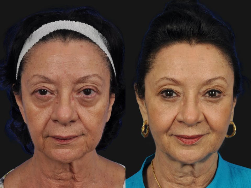 Mid Facelift Before & After Gallery - Patient 286431 - Image 1