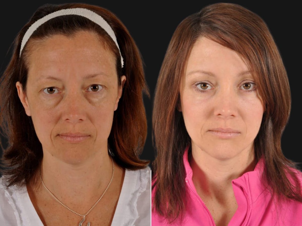 Mid Facelift Before & After Gallery - Patient 394554 - Image 1