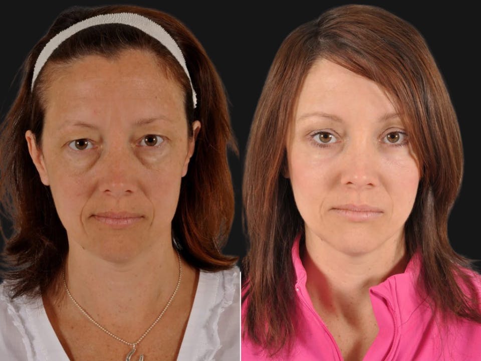 Mid Facelift Before & After Gallery - Patient 394554 - Image 1