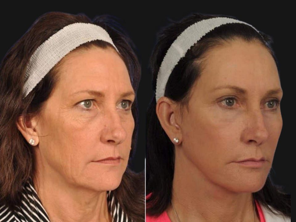Mid Facelift Before & After Gallery - Patient 323593 - Image 2