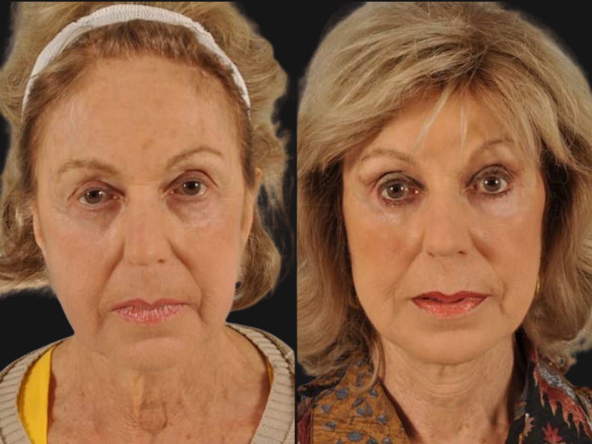 Mid Facelift Before & After Gallery - Patient 227892 - Image 1