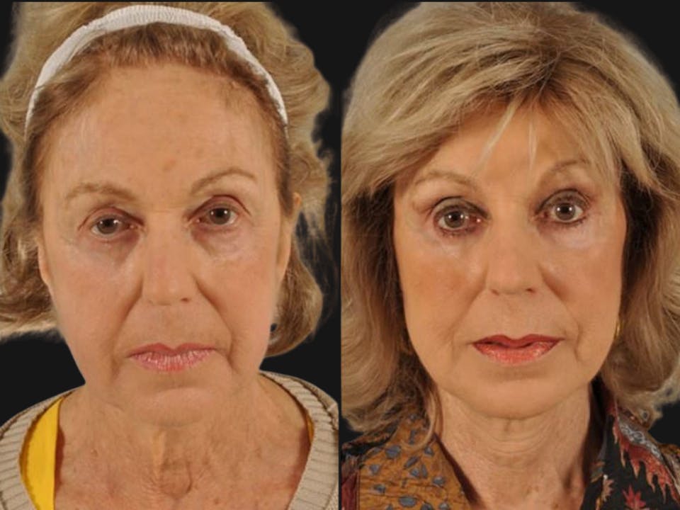 Mid Facelift Before & After Gallery - Patient 227892 - Image 1