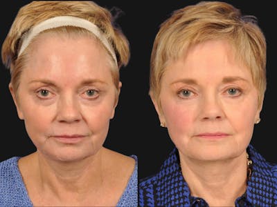 Mid Facelift Before & After Gallery - Patient 126803 - Image 1