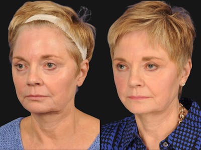 Mid Facelift Before & After Gallery - Patient 126803 - Image 2