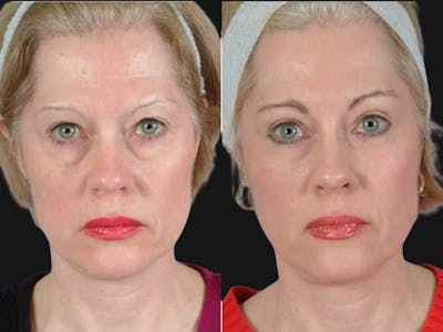 Mid Facelift Before & After Gallery - Patient 371325 - Image 1